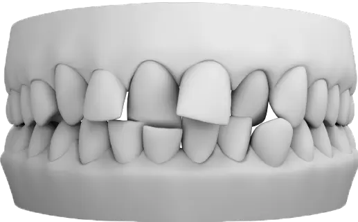 Crossbite & Underbite